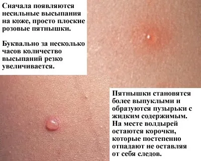Вітрянка (вітряна віспа) причини, симптоми, лікування