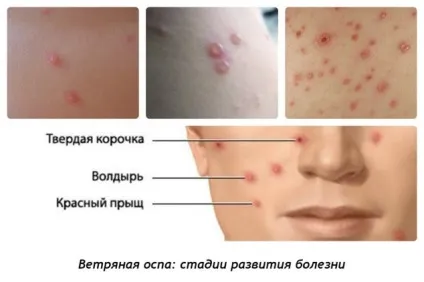 Вітрянка (вітряна віспа) причини, симптоми, лікування