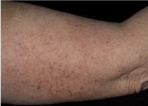 Cum de a vindeca eczeme pe mâini, picioare și a feței