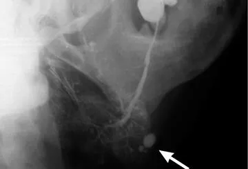 Stone tratament glandei salivare, diagnostic