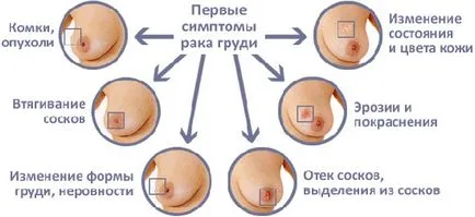 Карцином на гърдата какво е лечението на проникването, инвазивен муцинозна и