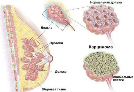 Emlőrák, mi az, kezelése beszivárgó, invazív mucinosus és