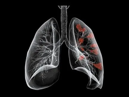 Lung karcinóma prognózisa a túlélés, a tünetek és a kezelés