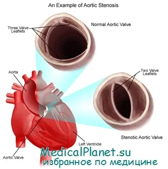 Клиника аортна стеноза