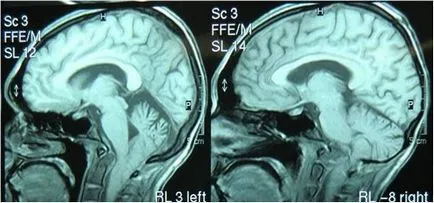 Кога трябва да се направи ядрено-магнитен резонанс и поведение MRI - медицински консултации