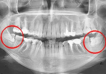 Когато конци са отстранени след отстраняване на мъдрец ви боли, колко се абсорбират, стоматологично лечение