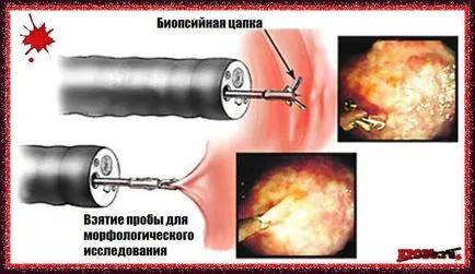 Свържи се с кървене - лечение на кървене