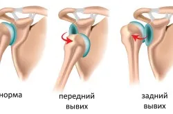 Вилітає плечовий суглоб що робити, профілактика (відео) (перший по суглобах) Вилітає плечовий суглоб що робити, профілактика (відео)