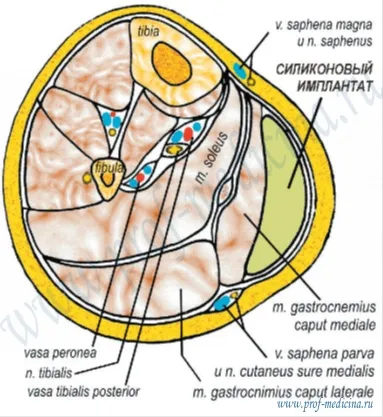 Kruroplastika - пластмаса пищял увеличение пищял, снимки преди и след kruroplastiki, прегледи на