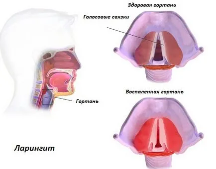 Ларингіт і трахеїт (ларингіт трахеїт) Ларингіт і трахеїт