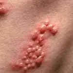 Tratamentul herpesului pe corp de remedii populare rapid - boli de piele - Articole Director - populare