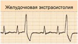 Лікування шлуночкової екстрасистолії