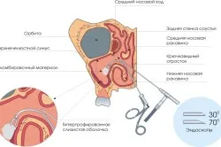 Лечение на синузит дафинов лист