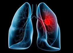 Tratamentul de remedii populare de cancer pulmonar