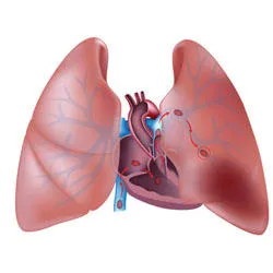 tromboză pulmonară - Tratamentul Inimii