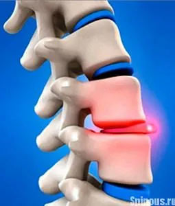 Tratamentul herniei spinării la recomandările de acasă exercițiu