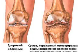 Лечение на всички форми на остеоартрит в Китай