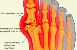 Лечение на всички форми на остеоартрит в Китай