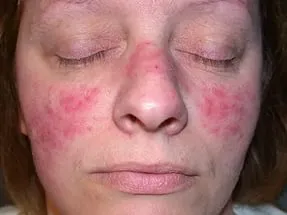 A rosacea kezelésének lézeres arc-, árak és vélemények