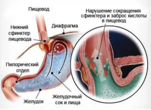 Reflux oesophagitis kezelésére a népi jogorvoslatok