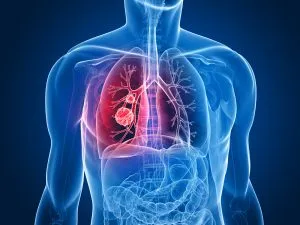 Tratarea cancerului pulmonar cu metastaze stadiul 4 remedii populare