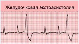 Лікування шлуночкової екстрасистолії