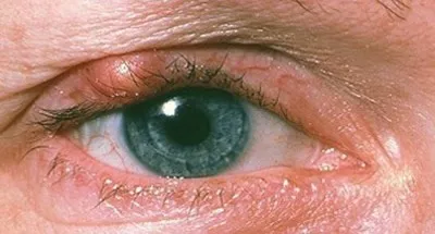 Студената лечение на ечемик в окото в дома лекарствата от народната медицина