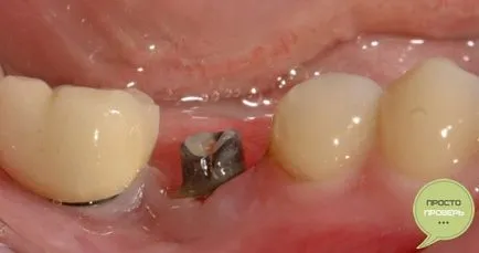 Kezelés és tünetek periimplantitis fotókkal és videó