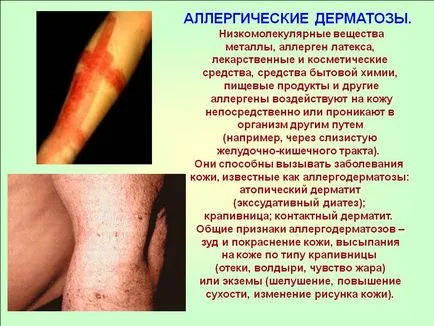 Tratamentul de ulei de cătină de diferite tipuri de dermatita