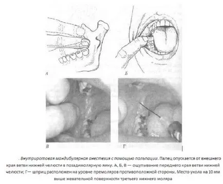 Alveolaris inferior blokk technikája Berchet tölgyek, és más módszerek verlotskomu