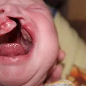 Вовча паща у дітей причини, радикальне усунення дефекту, фото до і після операції, відгуки