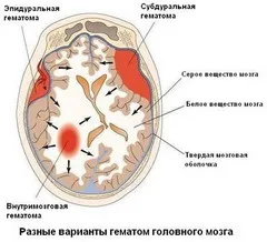 внутрішньочерепна гематома
