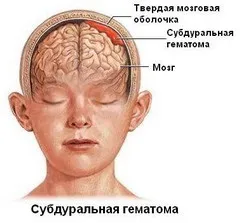 внутрішньочерепна гематома