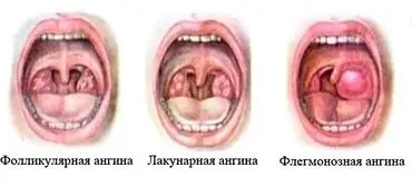 Запалення мигдалин в горлі причини, види та лікування (лікування) Запалення мигдалин в горлі причини, види та лікування