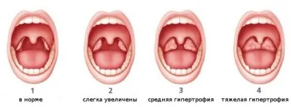 Запалення мигдалин в горлі причини, види та лікування (мигдалин) Запалення мигдалин в горлі причини, види та лікування