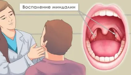 Запалення мигдалин в горлі причини, види та лікування (запалення глоткової мигдалини) Запалення мигдалин в горлі причини, види та лікування