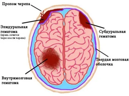 Внутрішньочерепна гематома причини, симптоми, діагностика, лікування