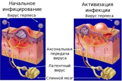 Мазь від генітального герпесу