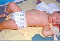 Meningita la copii - cauze, simptome, diagnostic și tratament