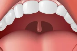 Previne palatal „limba“