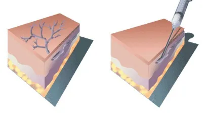 Mikroskleroterapiya - a választandó módszer, hogy megszabaduljunk a vaszkuláris - csillagok és vénák - cikkek -