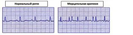 fibrilatie atriala cauze cardiace, simptome și tratament