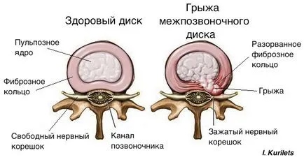 herniei de disc, dureri lombare, tratament hernie de disc, Centrul International de Neurochirurgie