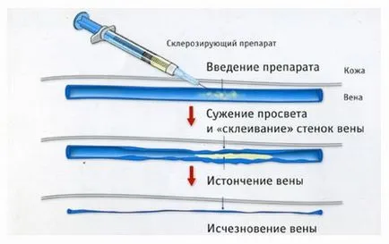 Mikroskleroterapiya разширени вени и разширени вени ревюта, функции и стопанство