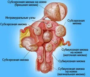 миома на матката симптоми, диагностика, профилактика