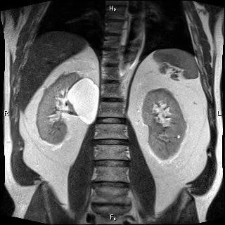 IRM a rinichilor, cu un contrast - acest lucru este interesant - HLS Messenger Arhiva - ziar HLS Monitorul