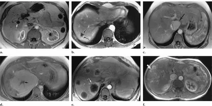 MRI a máj, amely megmutatja a vizsgálat előkészítése