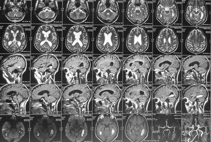 Brain MRI въпроси и отговори