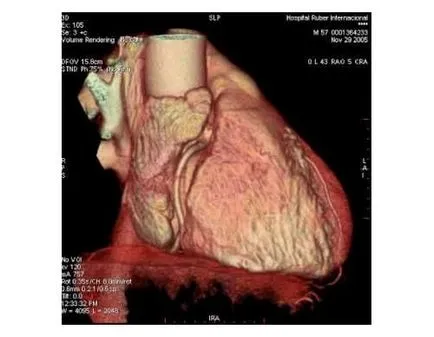 RMN cardiac cu un contrast care arată