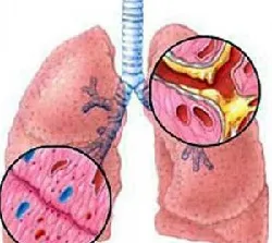 Folk jogorvoslati bronchitis - megelőzés és kezelés